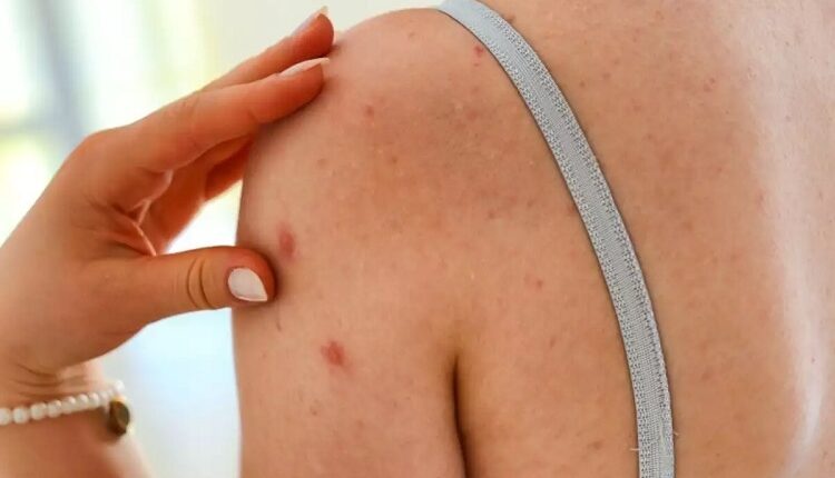 Acne Back