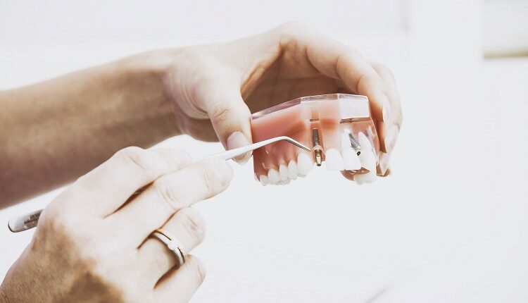 Dental Implants